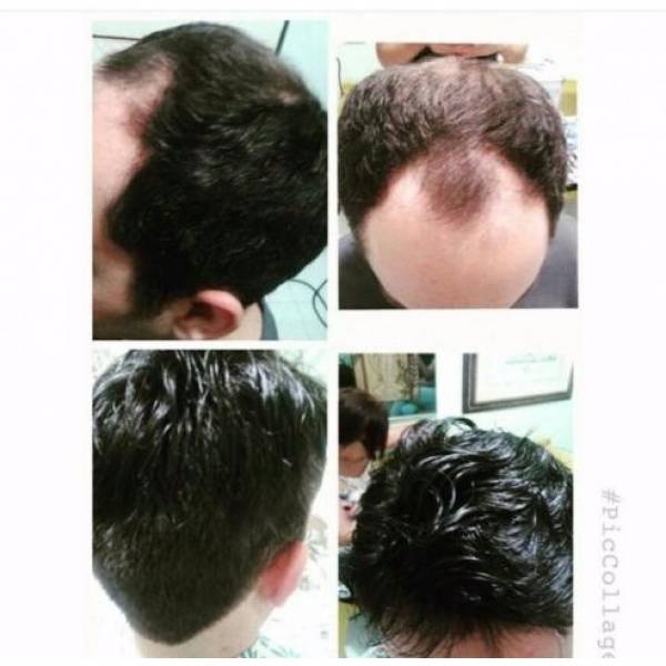 Implante de Cabelo Masculino 